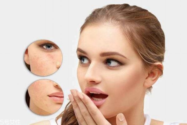 长痘痘的内在因素,长痘痘的内因和外因 长痘痘的内在因素,长痘痘的内因和外因