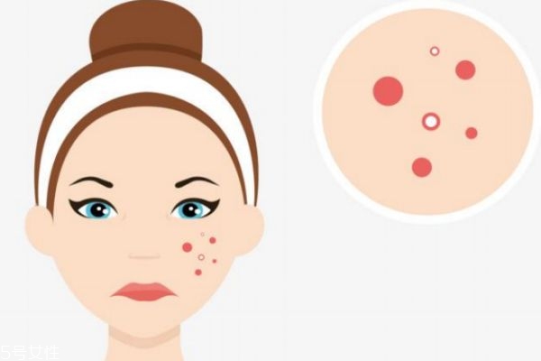 不同种类的痘痘以及处理方法,痘痘的分类和解决办法