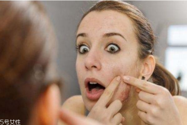 脸上长脓性痘痘怎么处理,脸上长脓痘什么原因怎么治疗 脸上长脓性痘痘怎么处理,脸上长脓痘什么原因怎么治疗