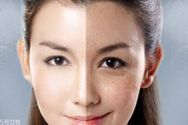 去脸上斑的小秘方,脸上有斑怎样去掉小妙招