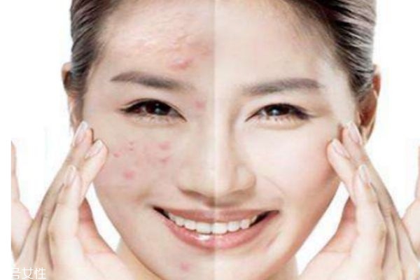 长痘痘的各种原因,到底什么原因长痘痘 长痘痘的各种原因,到底什么原因长痘痘