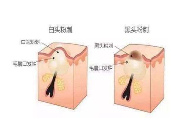 毛孔堵塞有什么方法可以解决,毛孔堵塞应该怎么办