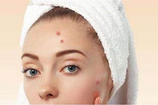 下巴处长痘,下巴长痘哪里有问题 下巴处长痘,下巴长痘哪里有问题