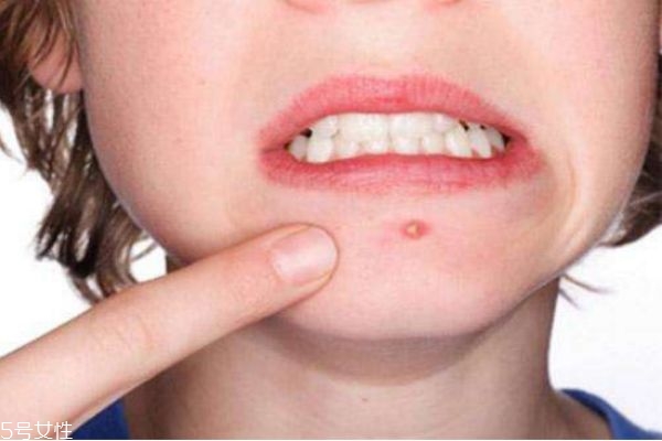 下巴长痘痘怎么快速去除,下巴长痘痘消除小妙招有哪些 下巴长痘痘怎么快速去除,下巴长痘痘消除小妙招有哪些
