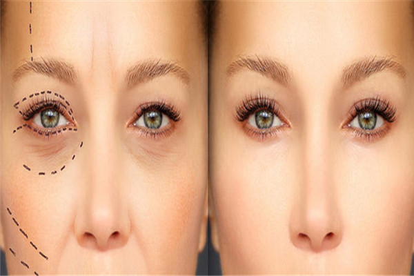 什么精油能去黑眼圈,去黑眼圈的精油