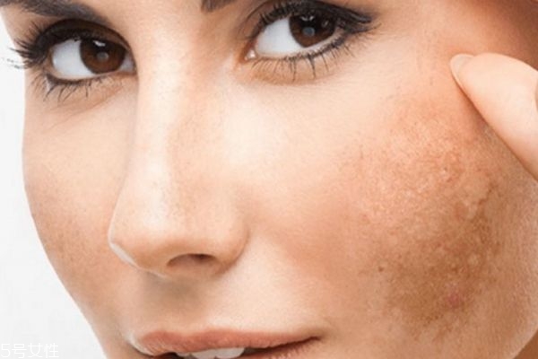 黄褐斑最好的治疗方法是什么?,怎样治疗黄褐斑效果更好