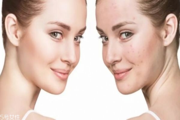 卸妆不干净长闭口痘,长闭口适合什么卸妆产品