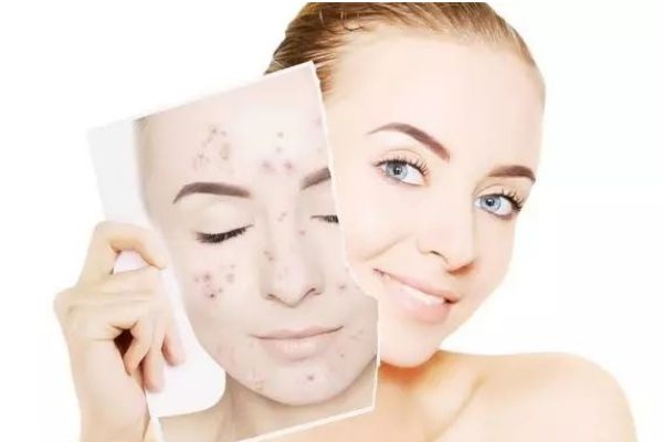 长痘痘要不要用护肤品,长痘是不是什么护肤品都不要用