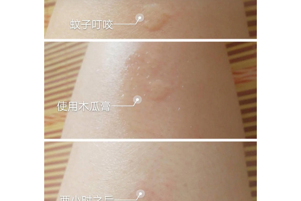 澳洲木瓜膏能止痒吗,澳洲木瓜膏可以止痒吗