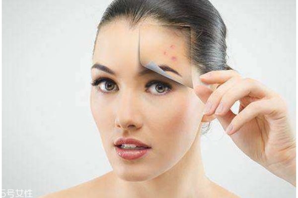 脸上色素沉着的原因,黑色素沉着是什么原因造成的 脸上色素沉着的原因,黑色素沉着是什么原因造成的