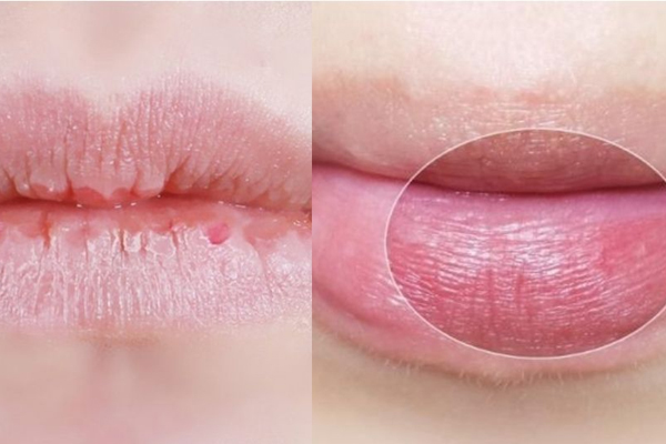 去除嘴上死皮小妙招,嘴巴上死皮用什么可以快速去除