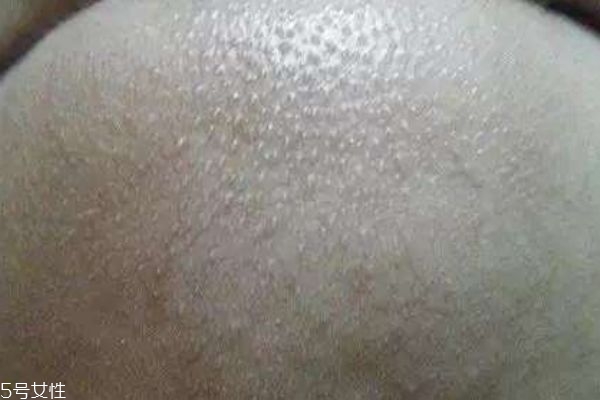 白头粉刺用什么药,白头粉刺的症状