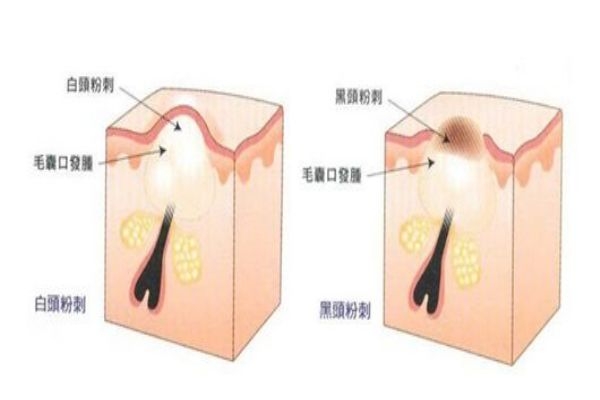 什么是白头粉刺图片,什么是白头粉刺?