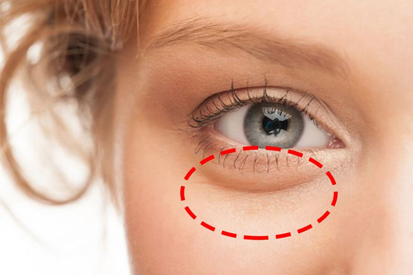 脂肪粒如何处理,脂肪粒去除后怎么护理