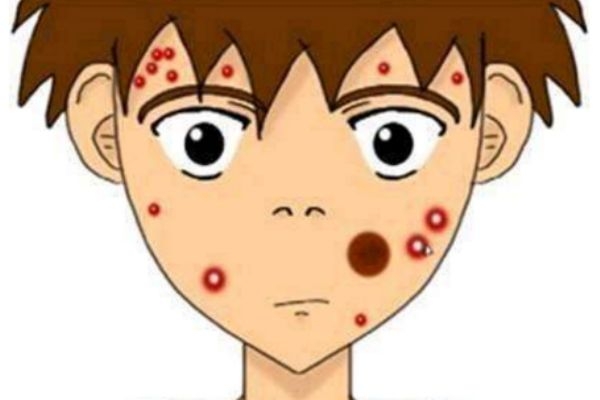 祛痘小妙招简单实用的方法,祛痘小妙招