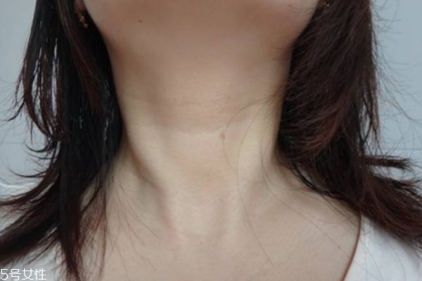 颈纹是不是根本消不掉,颈纹有办法消除吗