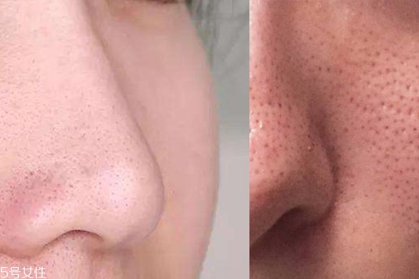收缩毛孔的方法,如何收缩毛孔