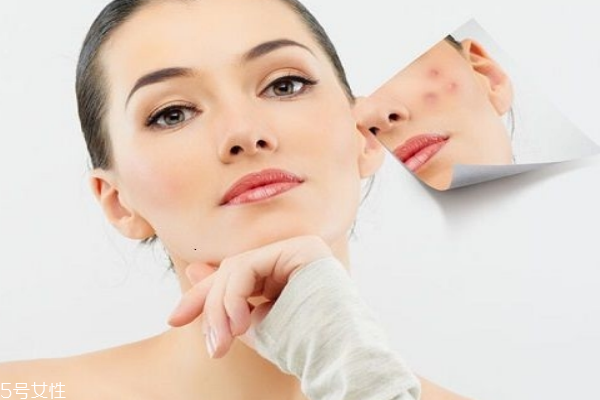 痘痘肌护肤小常识,痘肌护肤应该注意的问题