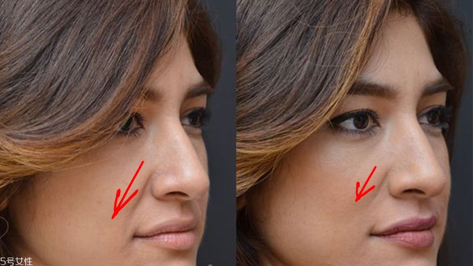 法令纹显老,有法令纹是不是就老了