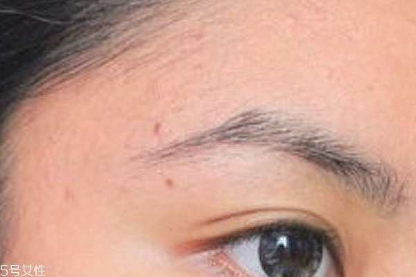 鼻子长痘是什么问题,鼻子长痘是