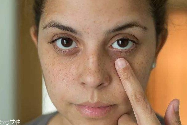 晒太阳后怎么防止变黑,被晒了怎么及时补救能不变黑 晒太阳后怎么防止变黑,被晒了怎么及时补救能不变黑