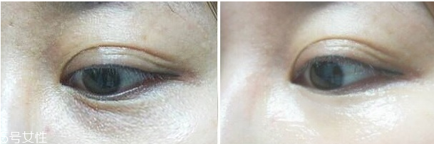 微针眼膜有用吗,微针眼膜怎么用