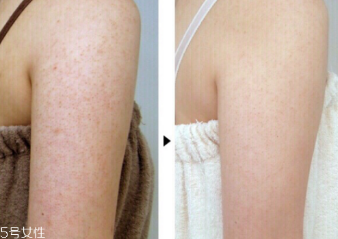 身体乳能去鸡皮肤吗,鸡皮肤越涂身体乳越严重