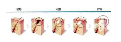 红肿痘痘的成因,红肿痘痘原因