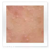 痘痘的种类图解,痘痘的种类有哪些