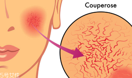 敏感肌肤用什么精油,敏感肌可以用精油护肤吗 敏感肌肤用什么精油,敏感肌可以用精油护肤吗