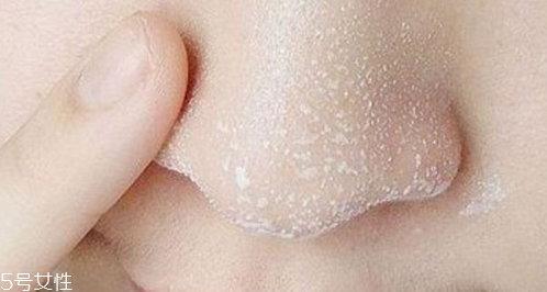 黑头不管它会自己消失吗,黑头不管他会自己消失吗 黑头不管它会自己消失吗,黑头不管他会自己消失吗