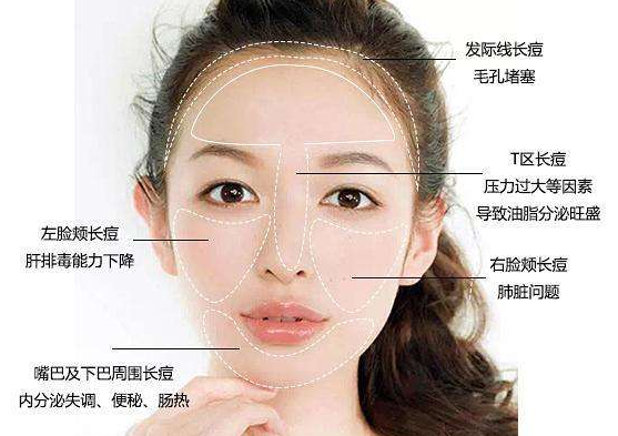 脸颊两侧长痘怎么治疗,面颊两侧长痘怎么办