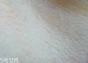 激光治疗鸡皮肤多少钱,激光治疗鸡皮肤靠谱吗 激光治疗鸡皮肤多少钱,激光治疗鸡皮肤靠谱吗