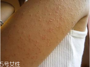 怎样去除鸡皮肤最好最快的速度,鸡皮肤如何根治