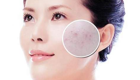 脸上长痘痘是什么原因引起的?,脸上长痘痘是什么原因,如何解决