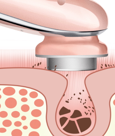美容仪会把角质层越来越薄吗,角质层薄能用导入仪吗