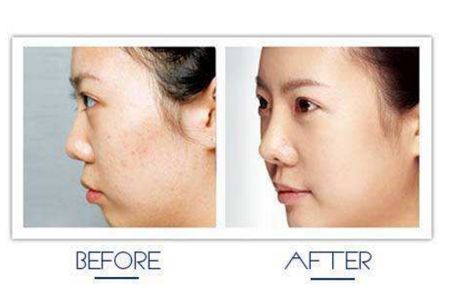 长痘痘了还能化妆吗,长痘期间可以化妆吗