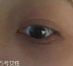 黑眼圈有几种类型,黑眼圈分为哪几种类型 黑眼圈有几种类型,黑眼圈分为哪几种类型