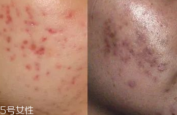 红痘印怎么护理,痘印平时怎么护理