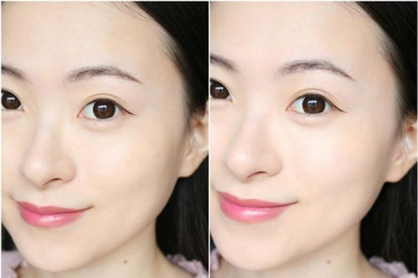 玻尿酸和除皱针有什么区别,除皱针和玻尿酸一样吗