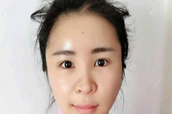 去眼袋的优点,去眼袋的利弊