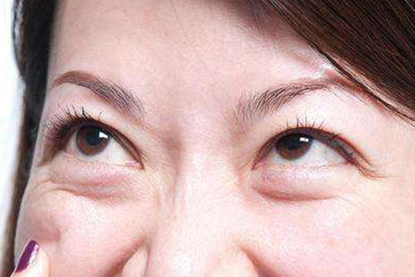 韩式去眼袋多少钱,亚韩去眼袋效果好吗