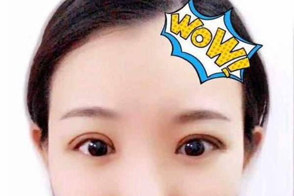 做眼睛手术后多久可以运动,视网膜手术后可以做什么运动