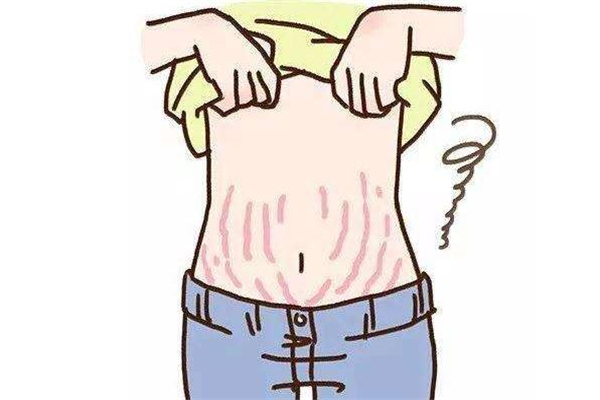 激光祛妊娠纹一般要做几次,激光能去妊娠纹吗