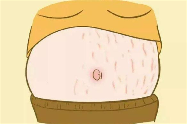 去妊娠纹激光多少钱,花2万激光去妊娠纹 去妊娠纹激光多少钱,花2万激光去妊娠纹