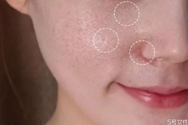 刚做完光子嫩肤怎么补水保湿,光子嫩肤后怎么补水保湿