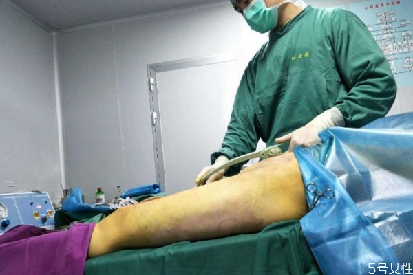 腿部抽脂恢复期是多久,腿部抽脂恢复期