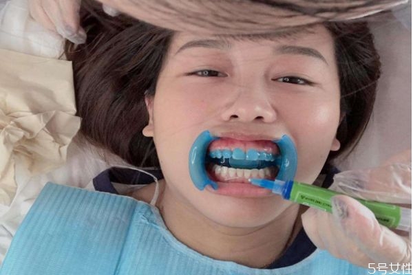 冰瓷美牙的副作用,冰瓷美牙有什么副作用