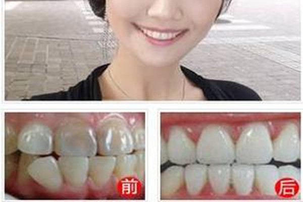 戴隐形牙套期间需要注意什么,隐形矫正需要注意什么