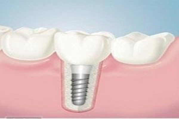 种植牙的周期分为几个阶段,种植牙分几个过程